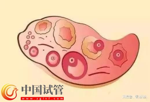 卵巢早衰卵泡不發育怎么辦?卵巢早衰可以借卵試管生孩子嗎?(圖7) 卵巢早衰卵泡不發育怎么辦?卵巢早衰可以借卵試管生孩子嗎?(圖7)