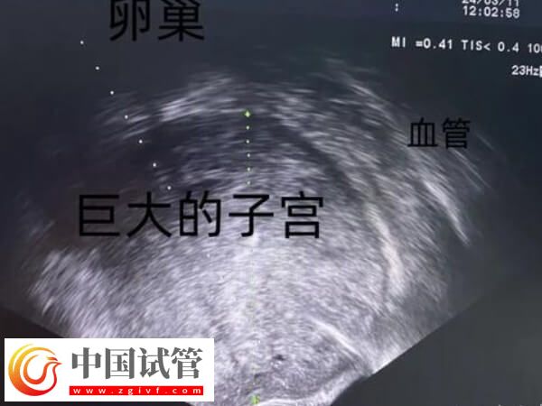 為什么41歲女人做試管嬰兒會失敗？背后真相大揭秘(圖2)