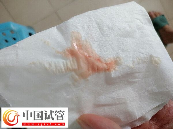 試管嬰兒取卵后月經(jīng)不調怎么回事(圖1) 試管嬰兒取卵后月經(jīng)不調怎么回事(圖1)