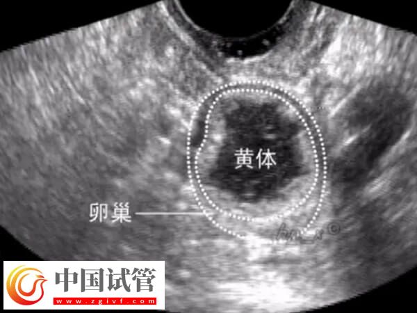 取卵后還有黃體殘留怎么辦(圖1)