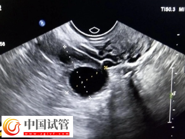 在美國做試管卵泡監測幾次能成功(圖1)