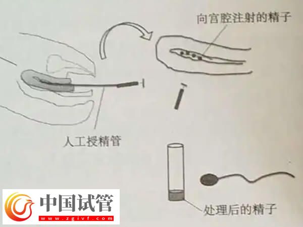 吉安市婦幼保健院人工授精的治療流程是怎么樣的?(圖3) 吉安市婦幼保健院人工授精的治療流程是怎么樣的?(圖3)