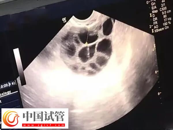 為什么打了促排針卵泡還長這么慢(圖1)