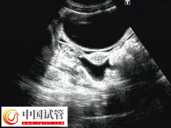 鮮胚移植后宮腔積液多久能吸收(圖1) 鮮胚移植后宮腔積液多久能吸收(圖1)