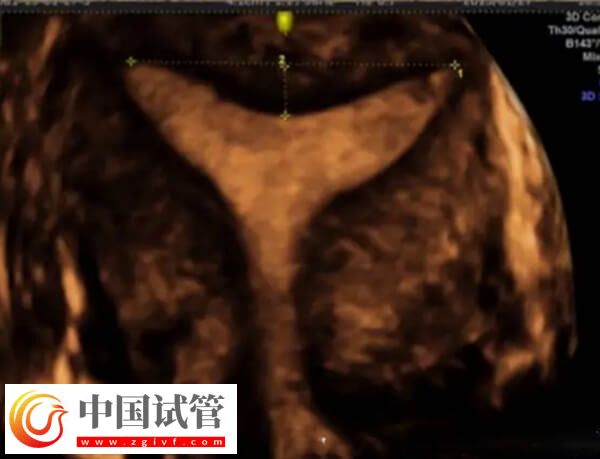 鮮胚移植后宮腔積液多久能吸收(圖2) 鮮胚移植后宮腔積液多久能吸收(圖2)