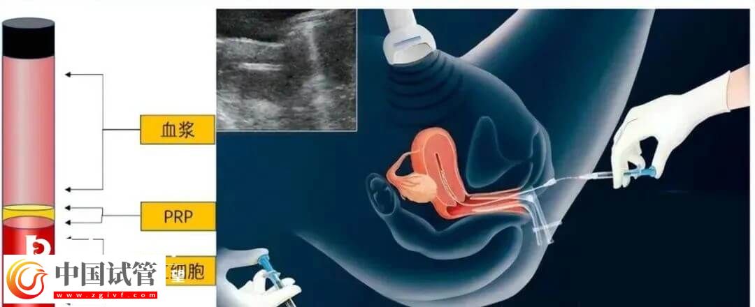 宮腔灌注具體的操作流程是怎么樣的？需要幾分鐘完成？(圖1)