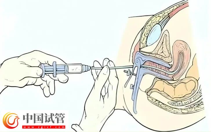 自體富血小板血漿PRP宮腔灌注過程安全無痛無創嗎？(圖1)
