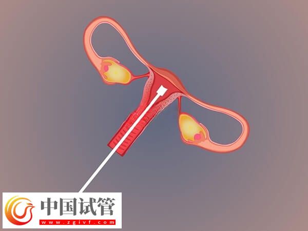 不經中介去泰國做試管要怎么做(圖1)