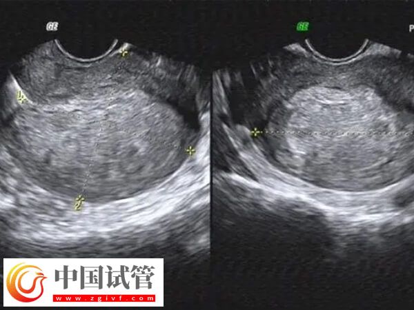 內膜移植窗口期一共查幾次(圖2)