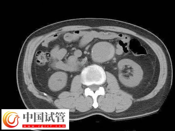 腹腔鏡子宮切除手術怎么做(圖3) 腹腔鏡子宮切除手術怎么做(圖3)