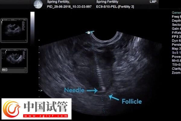 做試管嬰兒取卵后有腹水怎么辦(圖1)