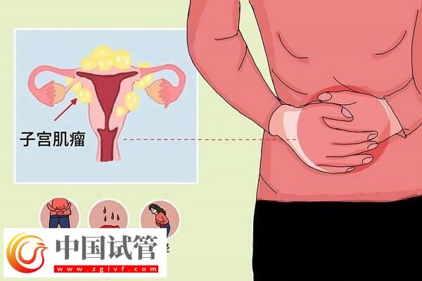 子宮肌瘤是什么原因?qū)е碌模繉＜医庾x子宮肌瘤的原因(圖1)