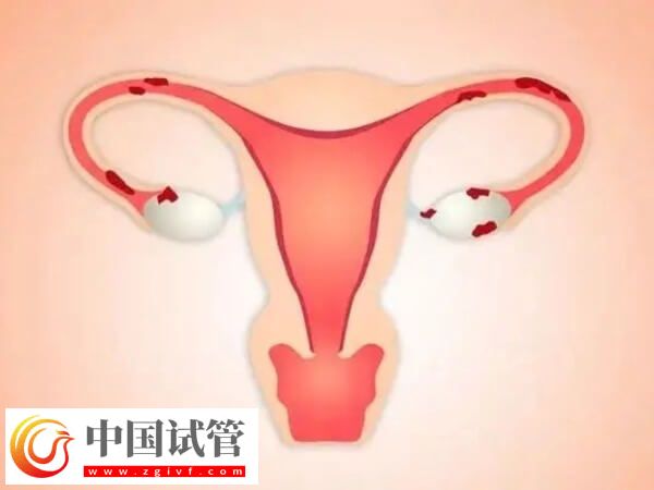 腔粘連不治會有什么后果(圖1)